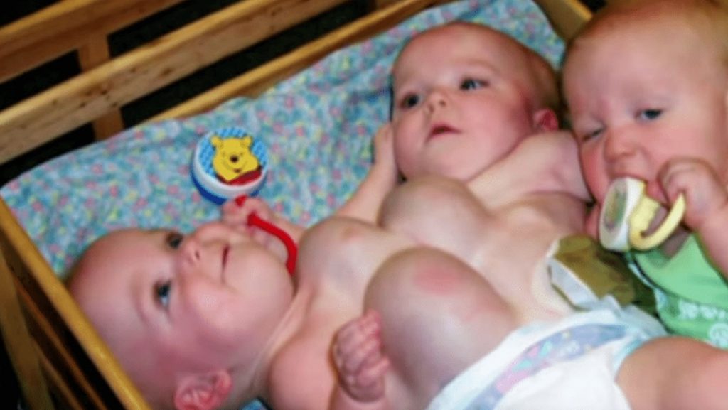 VIDEO: Rare Conjoined Twins Survived after Separation! 
